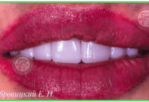 Голлівудська посмішка: де встановити вініри в Києві?