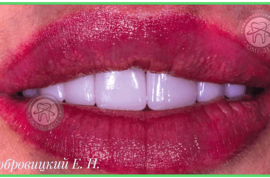 Голлівудська посмішка: де встановити вініри в Києві?